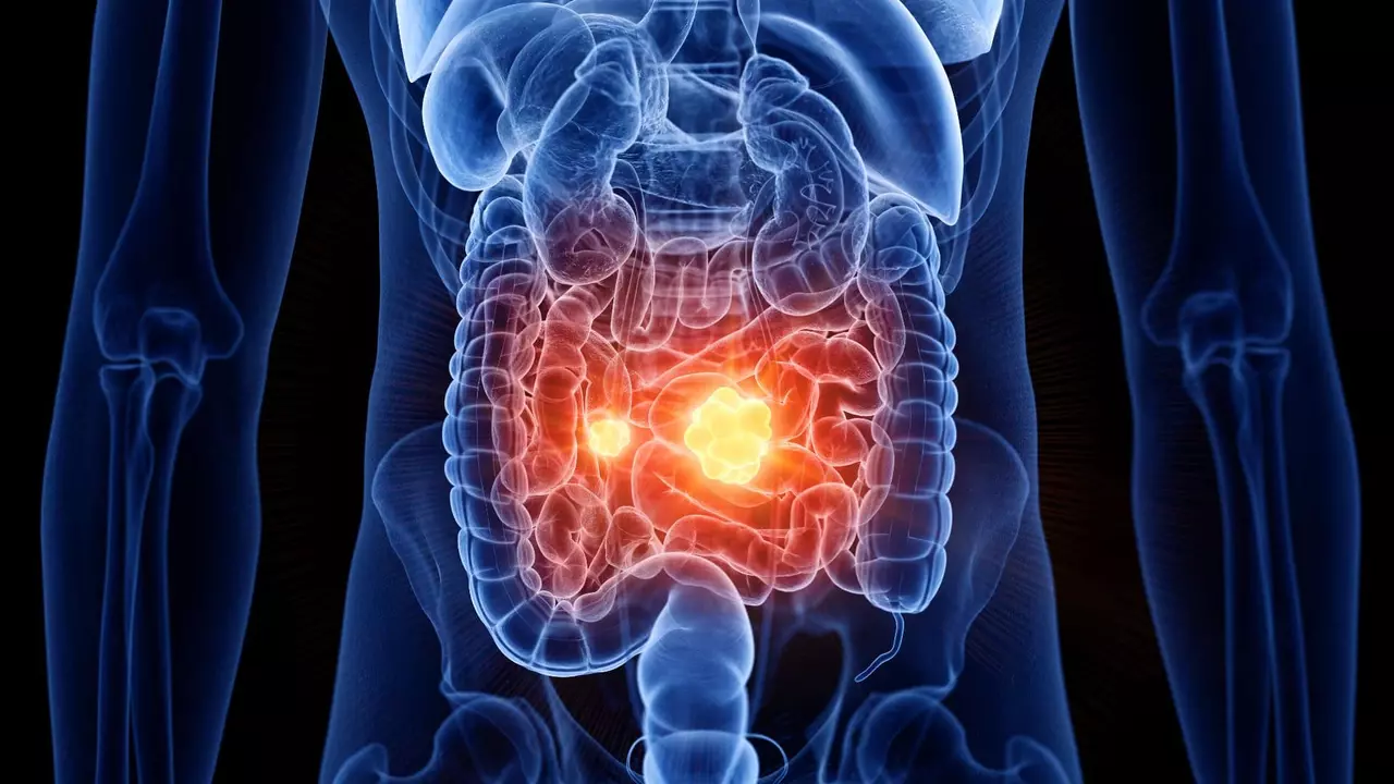 Le Rôle des Probiotiques dans la Gestion de la Maladie Inflammatoire de l'Intestin (MII)
